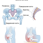Не можете сидеть из-за боли в копчике?   Это кокцигодиния